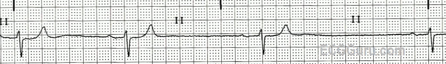 ecg-basics-sinus-bradycardia-with-first-degree-av-block-ecg-guru